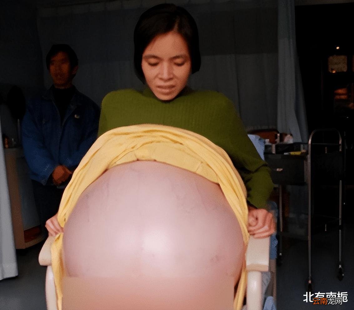 女子把腫瘤當(dāng)懷孕，挺巨肚撐12個(gè)月，腫瘤重達(dá)上百斤，如今怎樣？